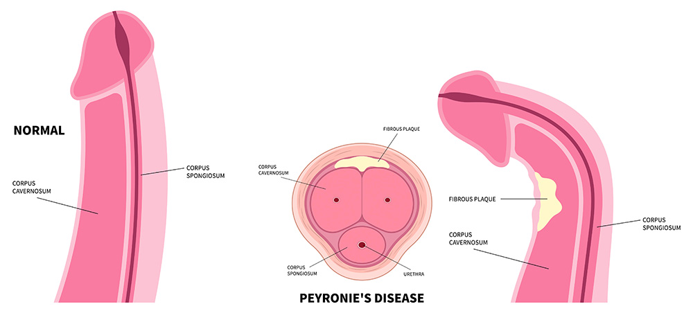 Peyronie's Disease